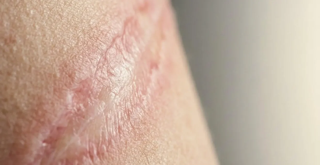 Dettaglio ravvicinato di pelle in fase di rigenerazione dopo ustione con focus su texture e processo di guarigione