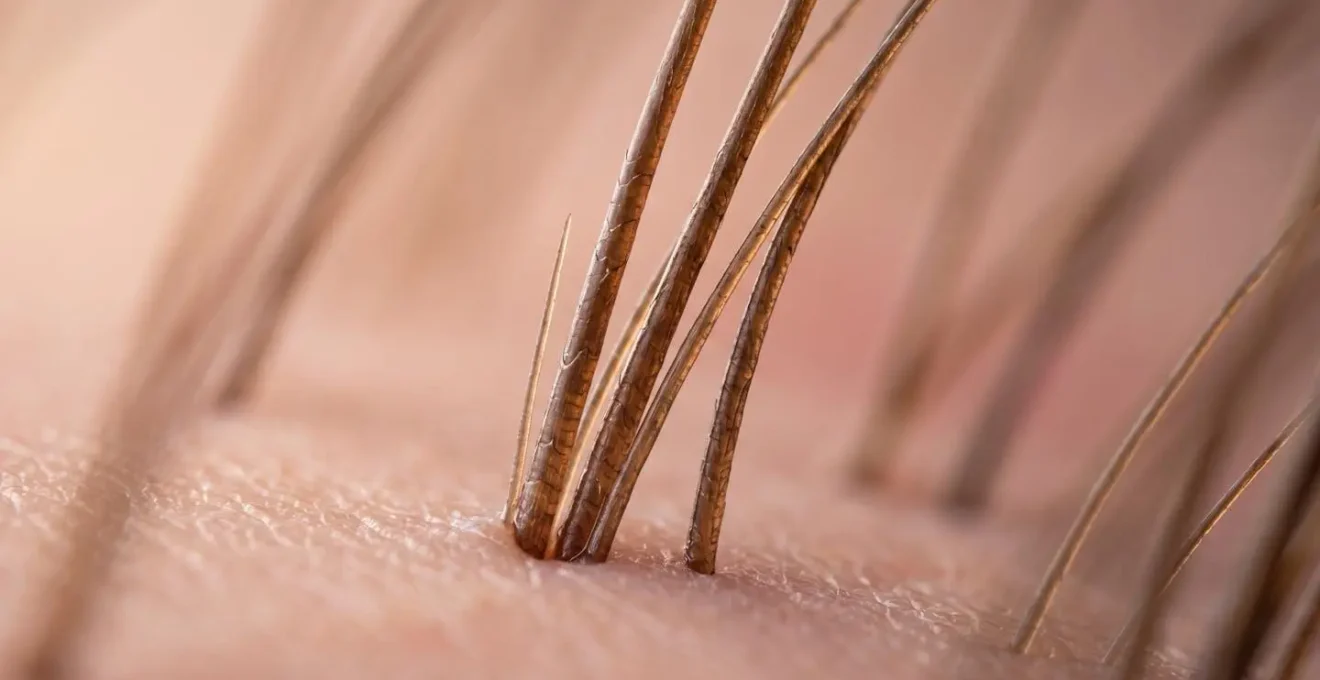 Dettaglio macro della zona posteriore del cuoio capelluto che mostra la delicata struttura della zona donatrice con follicoli piliferi